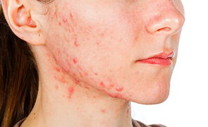 acne