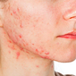 acne